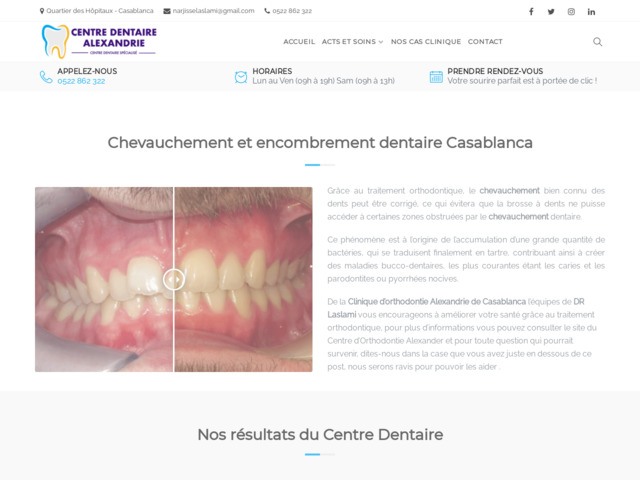 Encombrement dentaire  Casablanca