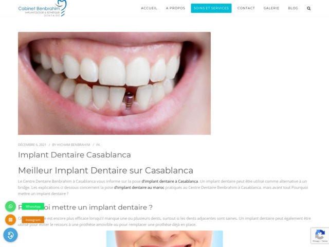 Implant dentaire casablanca