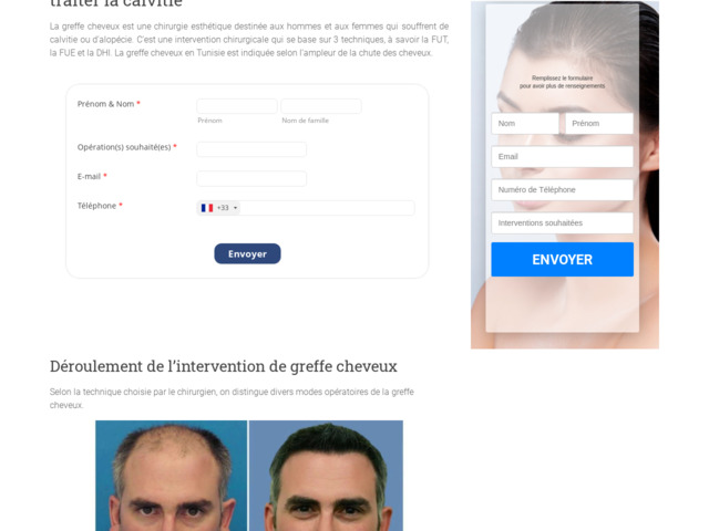 Greffe de cheveux DHI en Tunisie